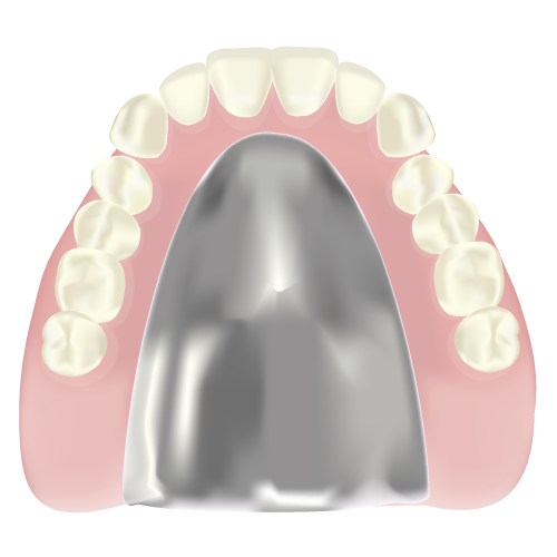 金属床義歯