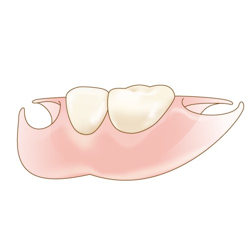 ノンクラスプデンチャー