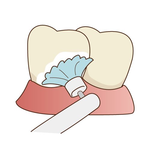 むし歯は予防が重要