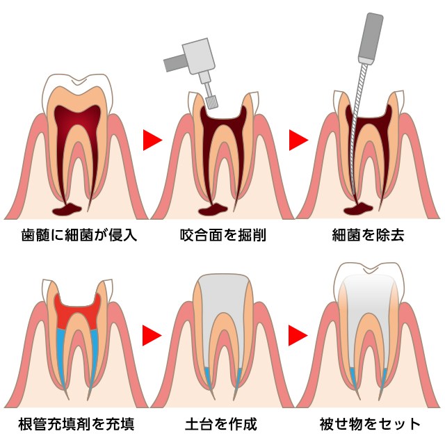 歯を残すための「根管治療」