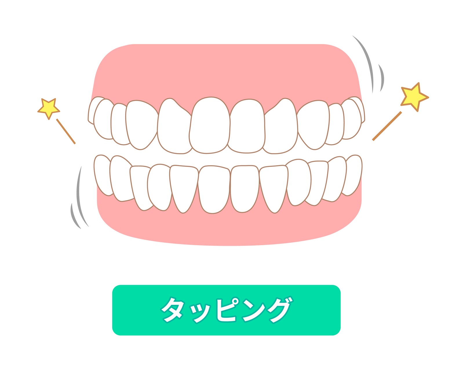 「タッピング」